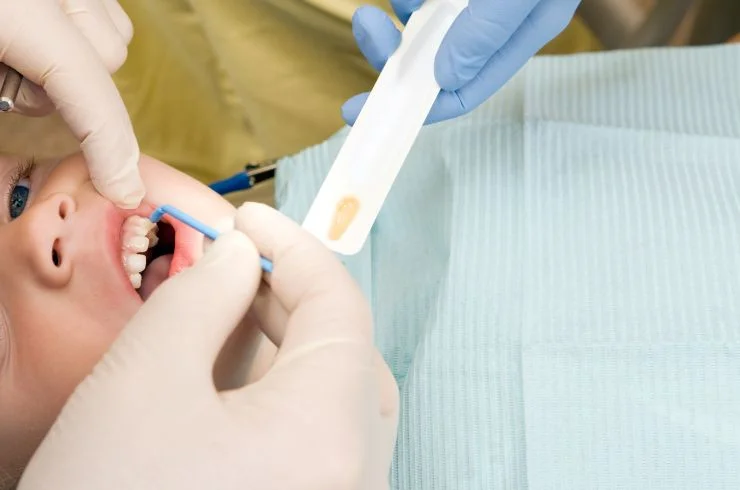 Fissure Sealants and Fluoride Application