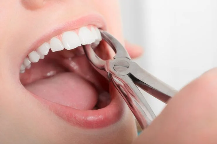 Wisdom Tooth Removal 2