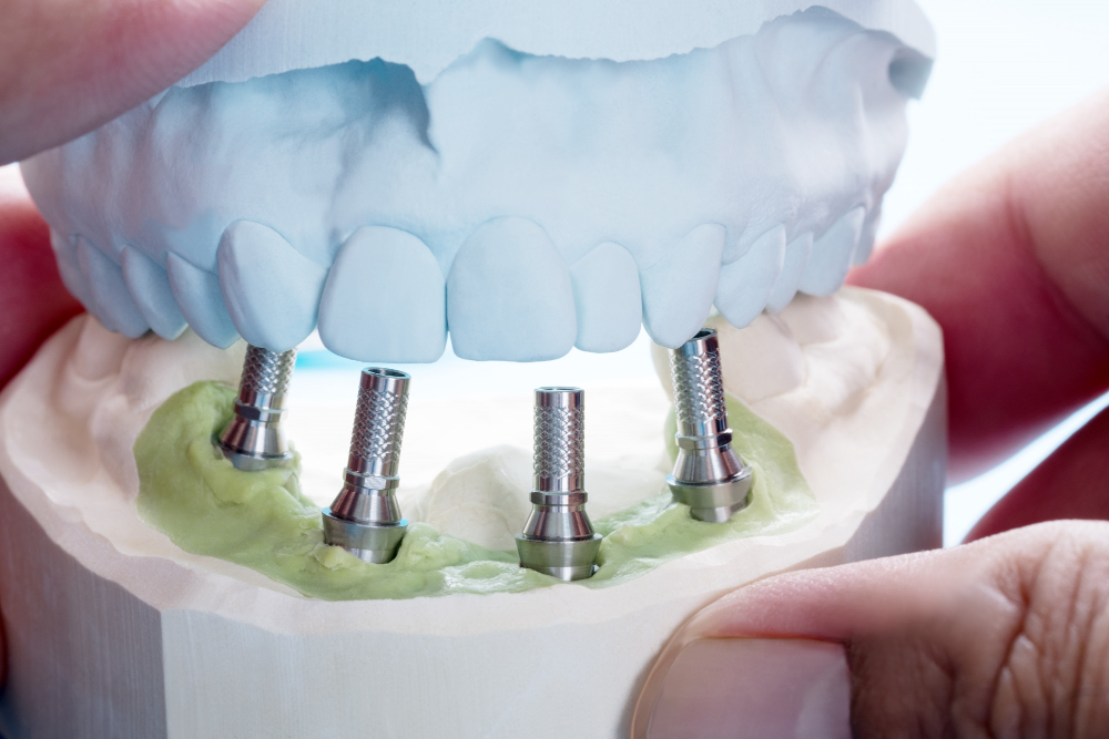 Single / Multiple Implant Placement